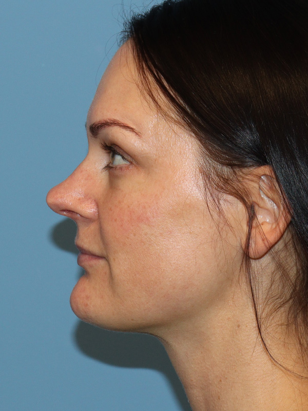 Rhinoplasty Before and After | SGK Plastic Surgery