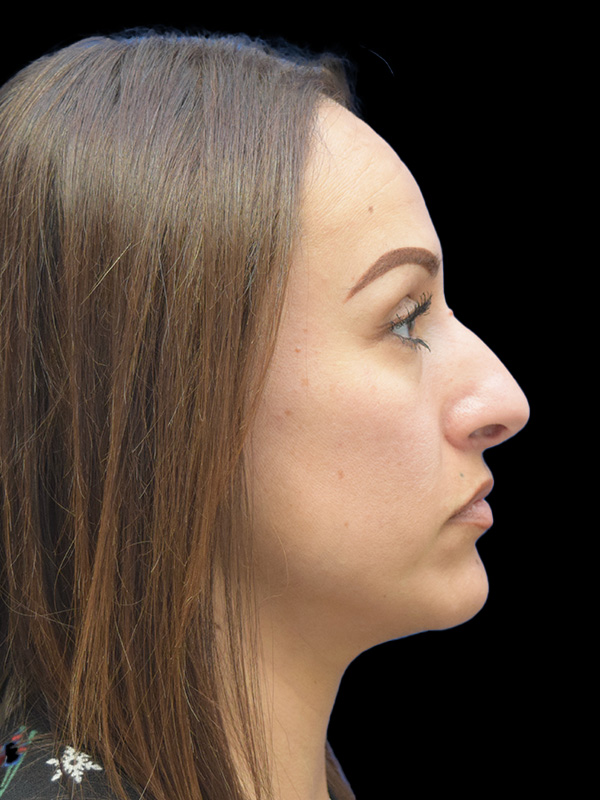 Rhinoplasty Before and After | SGK Plastic Surgery