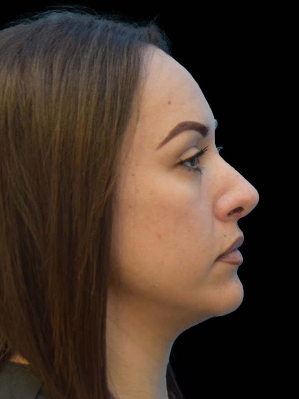 Rhinoplasty Before and After | SGK Plastic Surgery