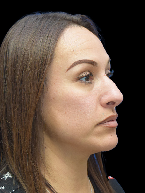 Rhinoplasty Before and After | SGK Plastic Surgery