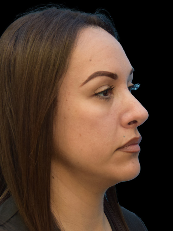 Rhinoplasty Before and After | SGK Plastic Surgery