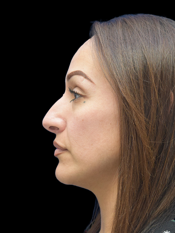 Rhinoplasty Before and After | SGK Plastic Surgery