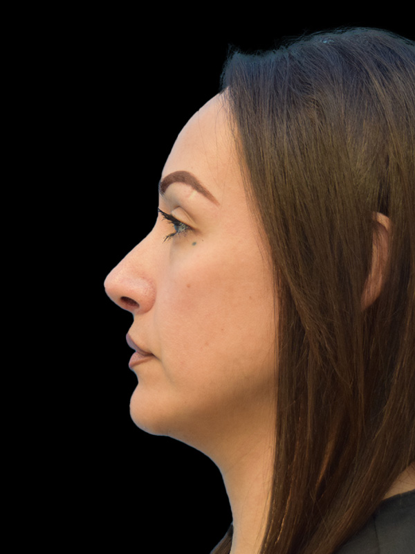 Rhinoplasty Before and After | SGK Plastic Surgery