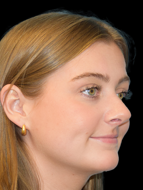 Rhinoplasty Before and After | SGK Plastic Surgery