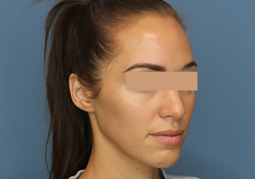 Injectables Before and After | SGK Plastic Surgery