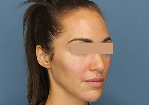 Injectables Before and After | SGK Plastic Surgery