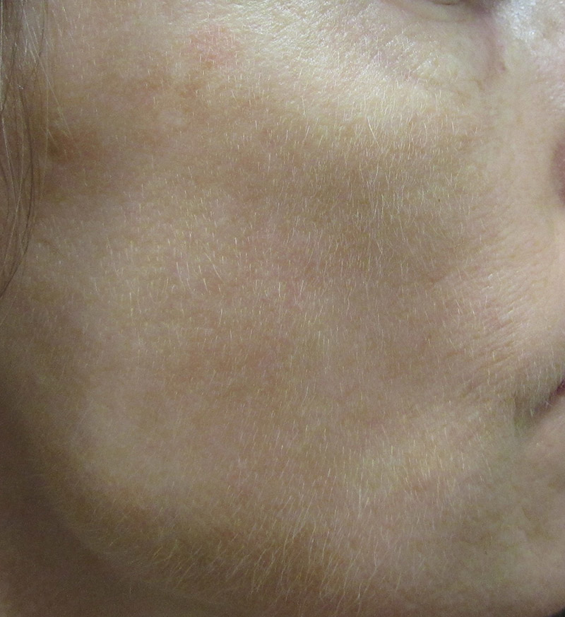 IPL Before and After | SGK Plastic Surgery